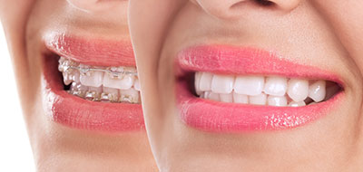 JEV DMD and Associates | Extractions, Ceramic Crowns and Wisdom Teeth Extractions
