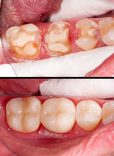 JEV DMD and Associates | Implant Dentistry, Oral Exams and Preventative Program