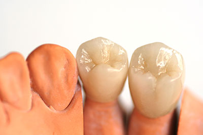 JEV DMD and Associates | Teeth Whitening, Ceramic Crowns and Dental Fillings