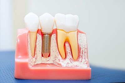 JEV DMD and Associates | Dental Cleanings, Root Canals and Dentures