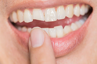 JEV DMD and Associates | Ceramic Crowns, Cosmetic Dentistry and Implant Dentistry