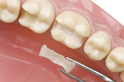 JEV DMD and Associates | Ceramic Crowns, Full Mouth Reconstruction and Extractions