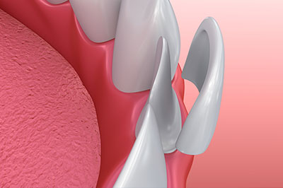 JEV DMD and Associates | Oral Exams, Dental Bridges and Veneers
