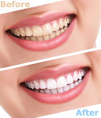 JEV DMD and Associates | Extractions, Ceramic Crowns and Cosmetic Dentistry