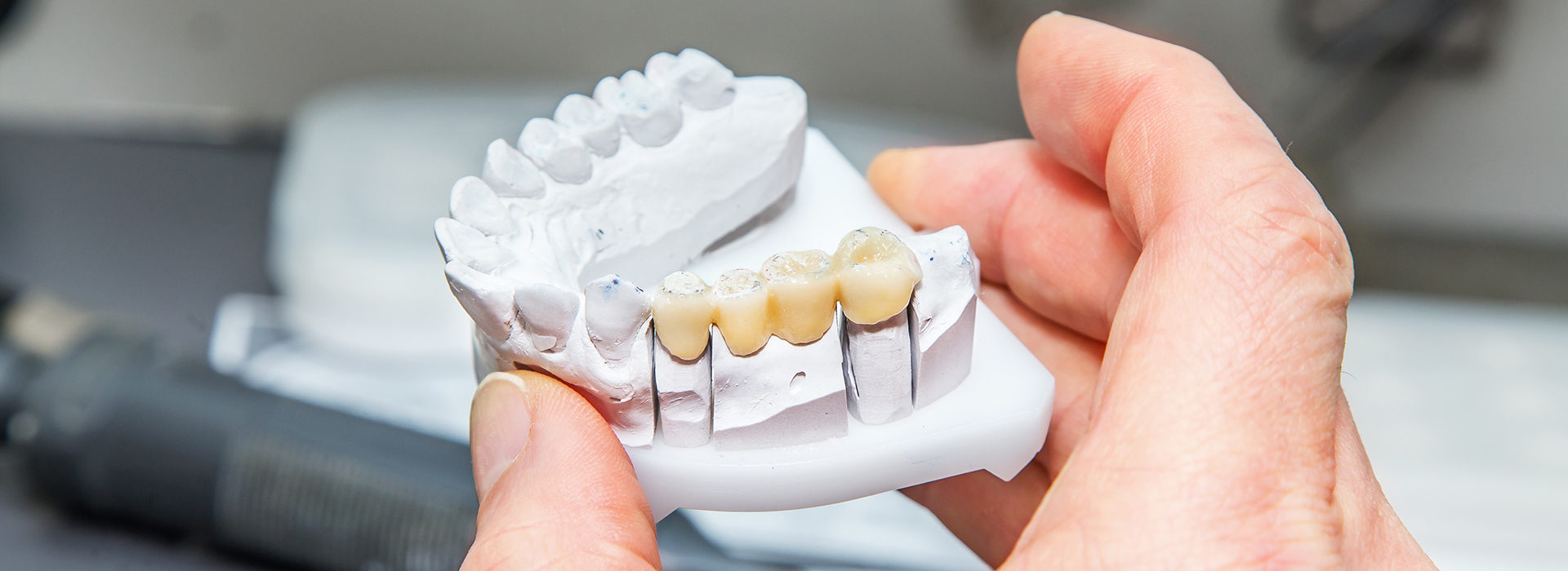 JEV DMD and Associates | Preventative Program, Dental Fillings and Dental Bonding