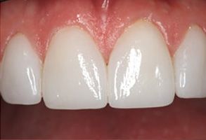 JEV DMD and Associates | Implant Dentistry, Ceramic Crowns and Veneers