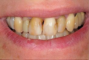 JEV DMD and Associates | Ceramic Crowns, Implant Restorations and Full Mouth Reconstruction
