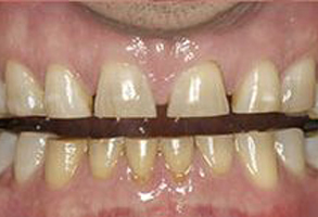 JEV DMD and Associates | Dental Bridges, Same Day Crowns and Ceramic Crowns